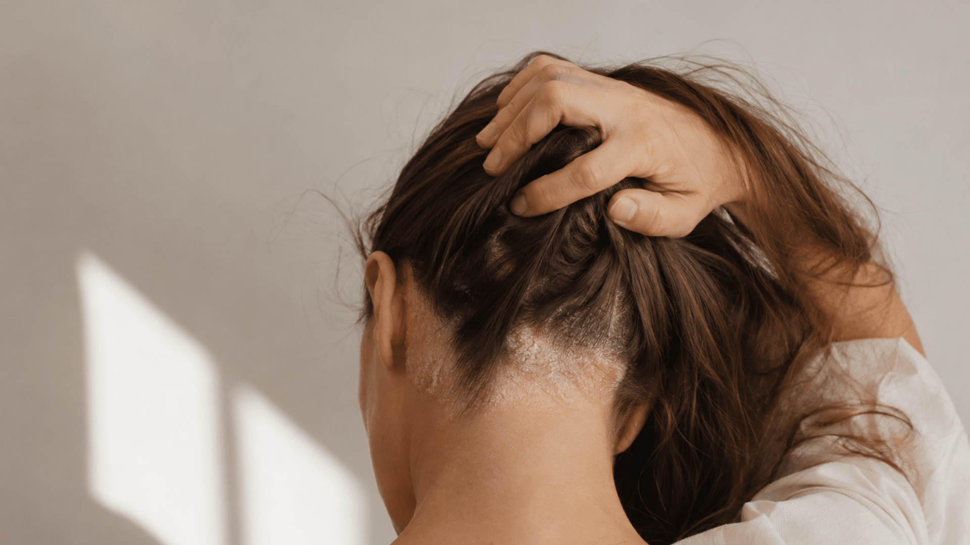 Top 7 Best Shampoos for Scalp Psoriasis in India What Is Scalp Psoriasis